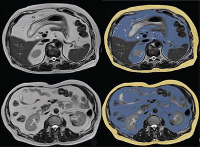 Towards visceral fat estimation at population scale: correlation of visceral adipose tissue assessment using three-dimensional cross-sectional imaging with BIA, DXA, and single-slice CT